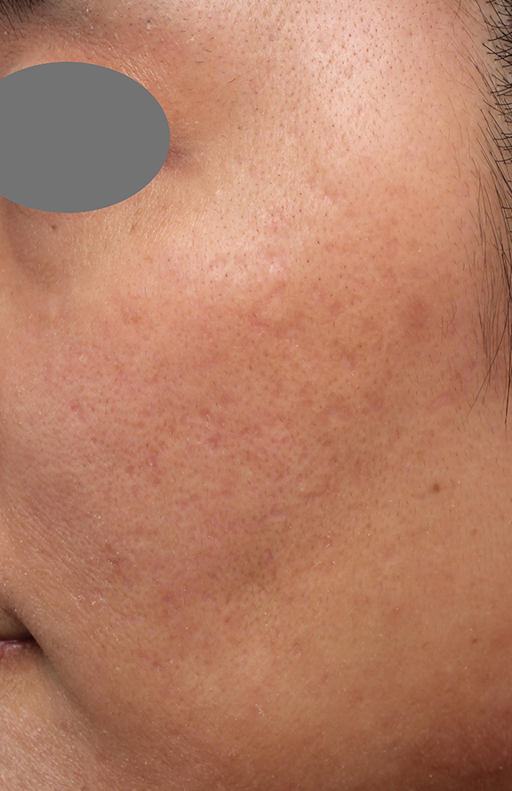 症例写真,ヴァンパイアフェイシャルの症例写真,After(6回目治療1ヶ月後),ba_vampirefacial001_b04.jpg