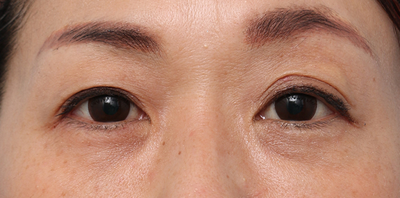 くぼみ目修正(ヒアルロン酸注射),くぼみ目ヒアルロン酸の症例写真,After(メイクあり)<br/>
(1週間後),ba_kubomi010_b02.jpg