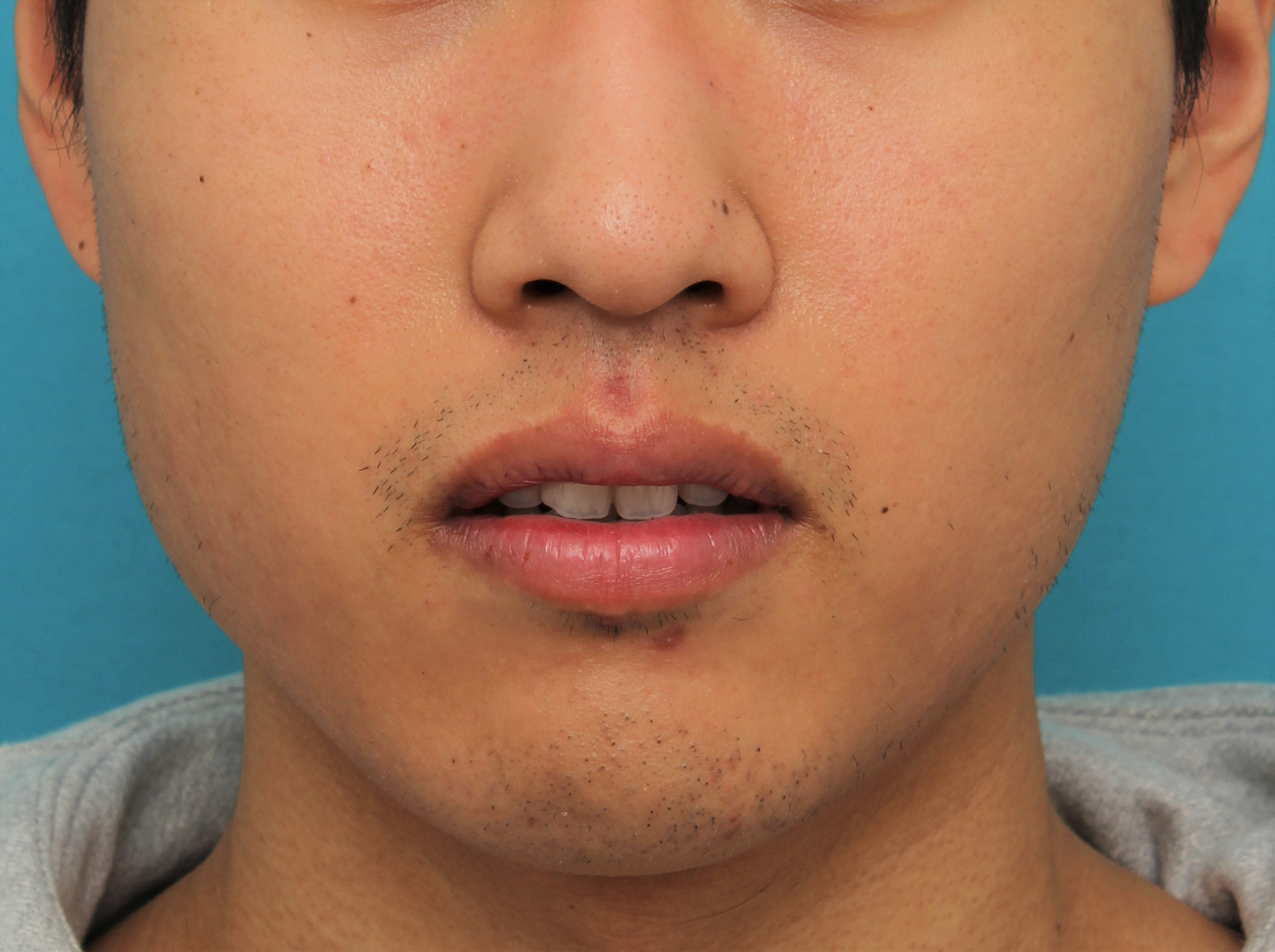 症例写真,手術で上下の唇を薄くした20代男性の症例写真,After(4ヶ月後),ba_usuku017_b02.jpg