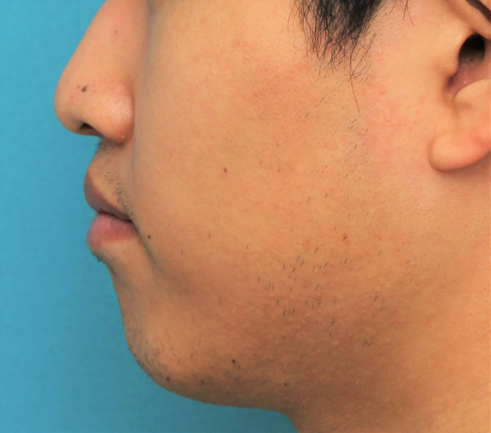 症例写真,手術で上下の唇を薄くした20代男性の症例写真,After(4ヶ月後),ba_usuku017_b03.jpg
