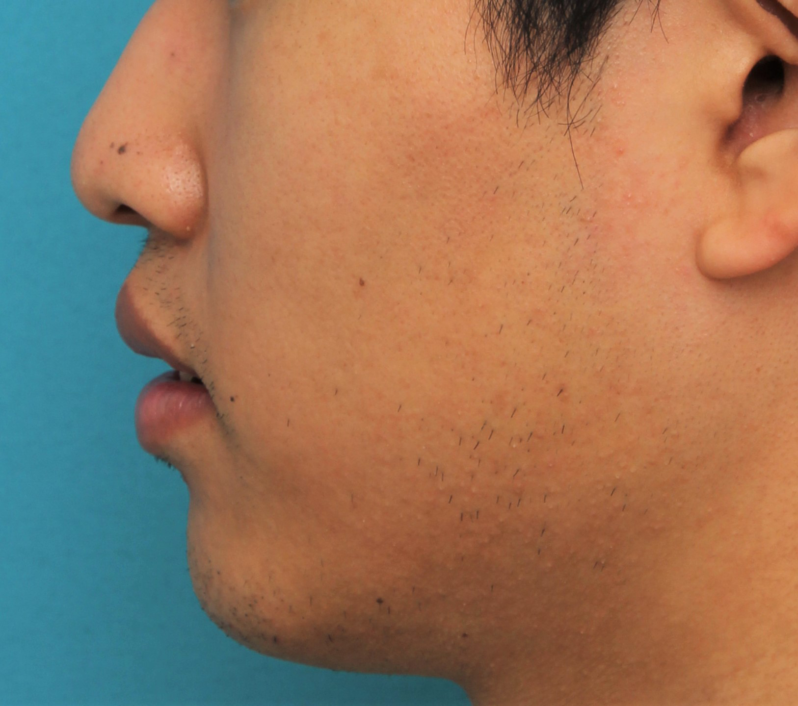 症例写真,手術で上下の唇を薄くした20代男性の症例写真,After(4ヶ月後),ba_usuku017_b04.jpg