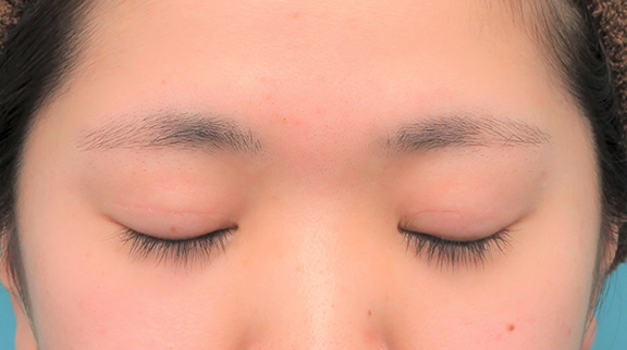 二重まぶた・全切開法,二重まぶた全切開法を行った20代女性の症例写真,After(6ヶ月後の目を閉じた状態),