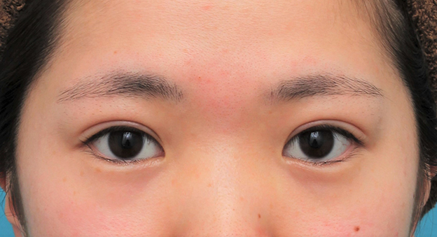 二重まぶた・全切開法,二重まぶた全切開法を行った20代女性の症例写真,2ヶ月後,目を開けた状態,mainpic_sekkai075h.jpg