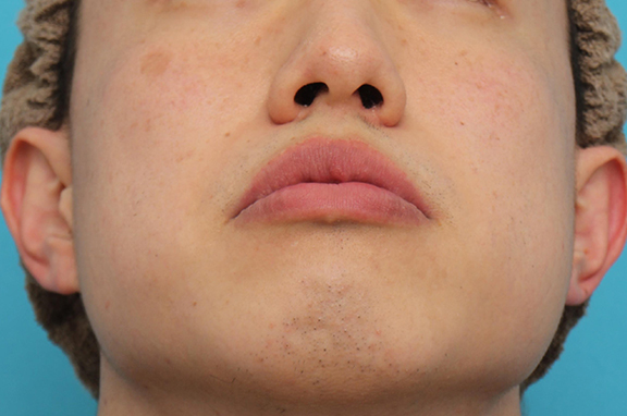 症例写真,上下口唇薄く(口唇縮小術)と鼻翼縮小術の症例写真,After(6ヶ月後),