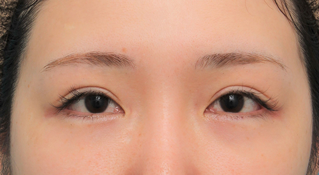 二重まぶた・全切開法,二重まぶた全切開法後、全切開して幅を狭く修正手術した20代女性の症例写真,6ヶ月後,目を開けた状態,mainpic_sekkai076i.jpg