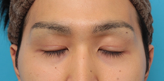 眼瞼下垂(がんけんかすい),眼瞼下垂の症例写真,After(3ヶ月後の目を閉じた状態),ba_ganken043_b02.jpg
