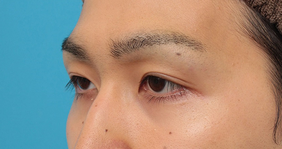 眼瞼下垂(がんけんかすい),眼瞼下垂の症例写真,After(3ヶ月後),ba_ganken043_b03.jpg