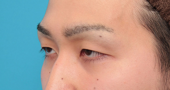 眼瞼下垂(がんけんかすい),眼瞼下垂の症例写真,Before,ba_ganken043_b03.jpg