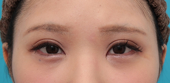 症例写真,全切開二重・目頭切開・垂れ目形成の症例写真,After(メイクあり)<br/>
(6ヶ月後),