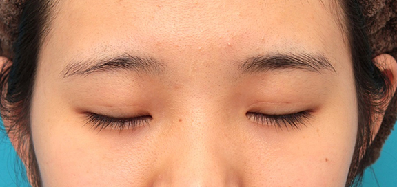 症例写真,埋没法の症例写真,After(1ヶ月後),ba_maibotsu062_b02.jpg