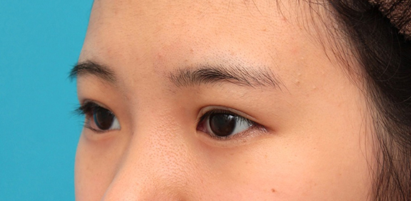 症例写真,埋没法の症例写真,After(1ヶ月後),ba_maibotsu062_b03.jpg