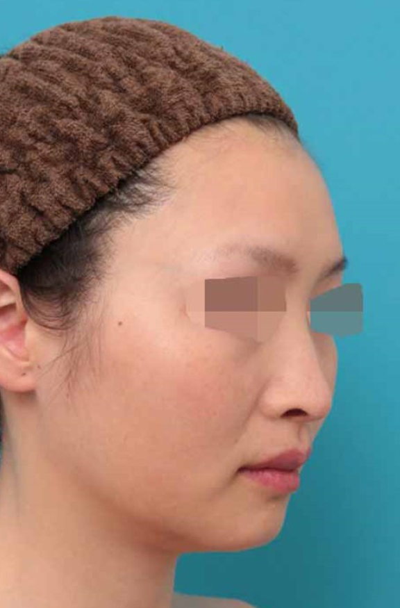 鼻中隔延長(鼻先を大きく下方に延ばす),鼻中隔延長術の症例写真,After(6ヶ月後),ba_bichukaku005_b02.jpg