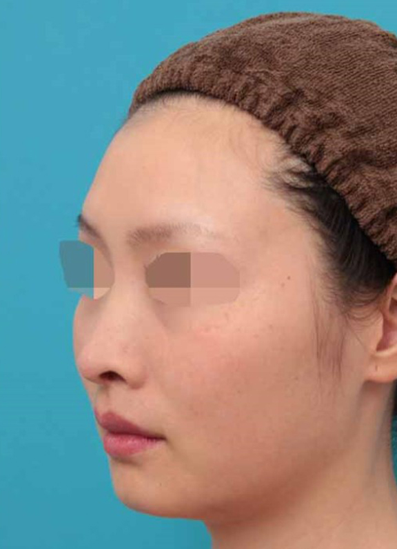 鼻中隔延長(鼻先を大きく下方に延ばす),鼻中隔延長術の症例写真,After(6ヶ月後),ba_bichukaku005_b03.jpg