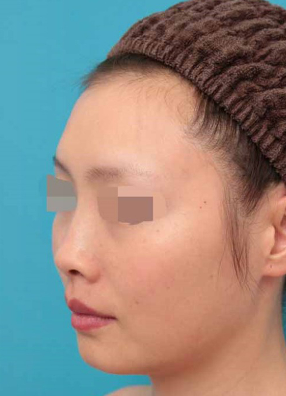 鼻中隔延長(鼻先を大きく下方に延ばす),鼻中隔延長術の症例写真,Before,ba_bichukaku005_b03.jpg