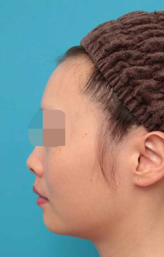 鼻中隔延長(鼻先を大きく下方に延ばす),鼻中隔延長術の症例写真,Before,ba_bichukaku005_b04.jpg