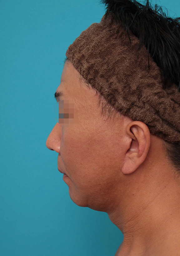 症例写真,ミディアムフェイスリフトの症例写真,After(6ヶ月後),ba_mediumlift017_b02.jpg