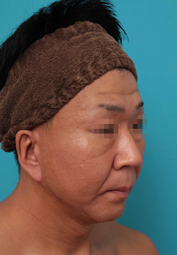 症例写真,ミディアムフェイスリフトの症例写真,After(6ヶ月後),ba_mediumlift017_b03.jpg