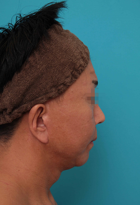 症例写真,ミディアムフェイスリフトの症例写真,After(6ヶ月後),ba_mediumlift017_b04.jpg