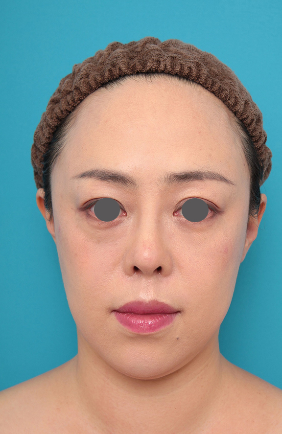 症例写真,鼻プロテーゼ、耳介軟骨移植の症例写真,After(メイクあり)<br/>
(1ヶ月後),
