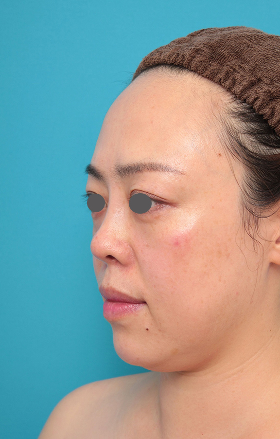 症例写真,鼻プロテーゼ、耳介軟骨移植の症例写真,After(メイクなし)<br/>
(1ヶ月後),ba_ryubi1058_b02.jpg