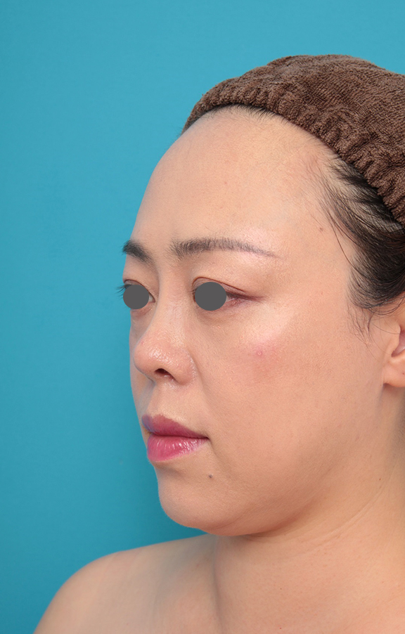 症例写真,鼻プロテーゼ、耳介軟骨移植の症例写真,After(メイクあり)<br/>
(1ヶ月後),