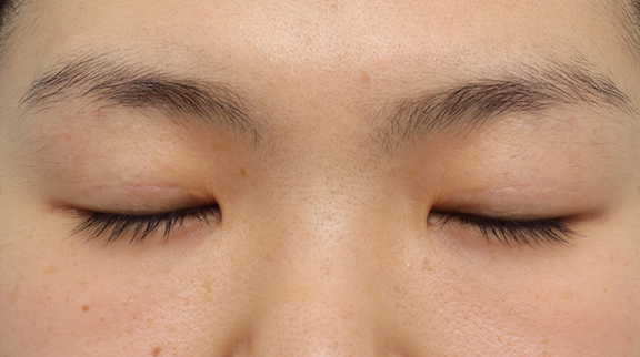 症例写真,二重まぶた・全切開法の症例 両側切開二重術施行後6ヶ月の経過,After(6ヶ月後の目を閉じた状態),ba_sekkai078_b02.jpg