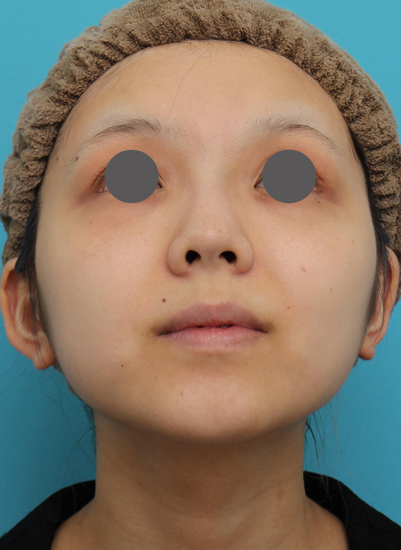 症例写真,鼻翼縮小(小鼻縮小)の症例写真 術後6ヶ月の経過,Before,ba_biyoku052_b02.jpg