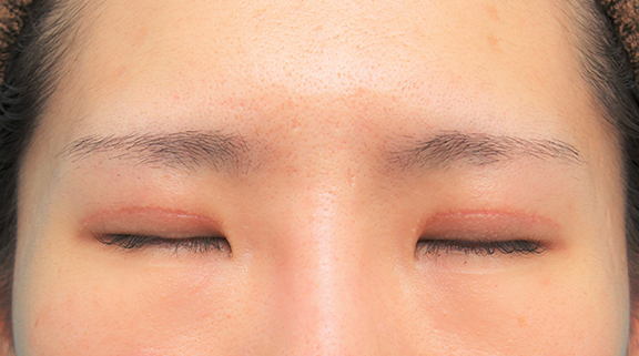 症例写真,他院切開二重後、幅を狭くして左右差を修正した20代女性の症例写真,After(2ヶ月後の目を閉じた状態),ba_sekkai079_b02.jpg