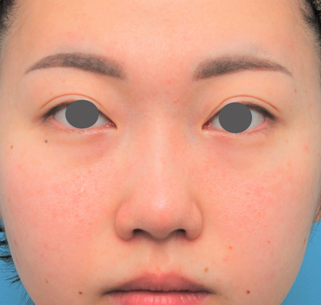 鼻尖形成(鼻尖縮小・だんご鼻修正),鼻尖縮小+小鼻縮小+鼻先、鼻柱の耳介軟骨移植+鼻筋のヒアルロン酸注射の症例写真,3週間後,mainpic_bisen030d.jpg