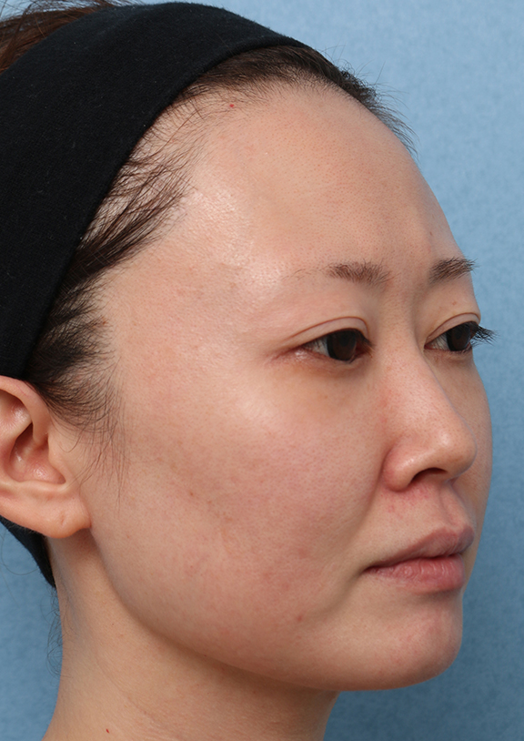 症例写真,【シミ治療】ピコレーザー&トレチノインの症例写真,After(1ヶ月後),ba_picoway001_b03.jpg