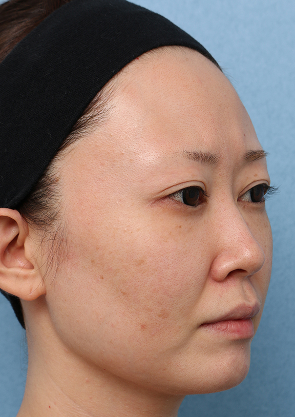 症例写真,【シミ治療】ピコレーザー&トレチノインの症例写真,Before,ba_picoway001_b03.jpg
