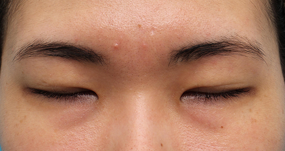 二重まぶた・全切開法,二重まぶた・全切開法+目頭切開の症例写真,Before,ba_sekkai081_b02.jpg
