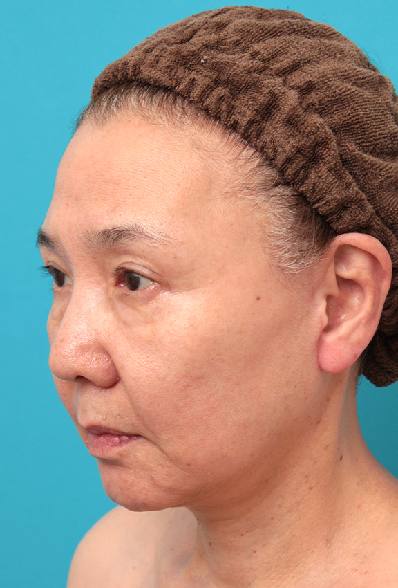 症例写真,フルフェイスリフトを行った60代女性の症例写真,After(6ヶ月後),ba_facelift007_b02.jpg