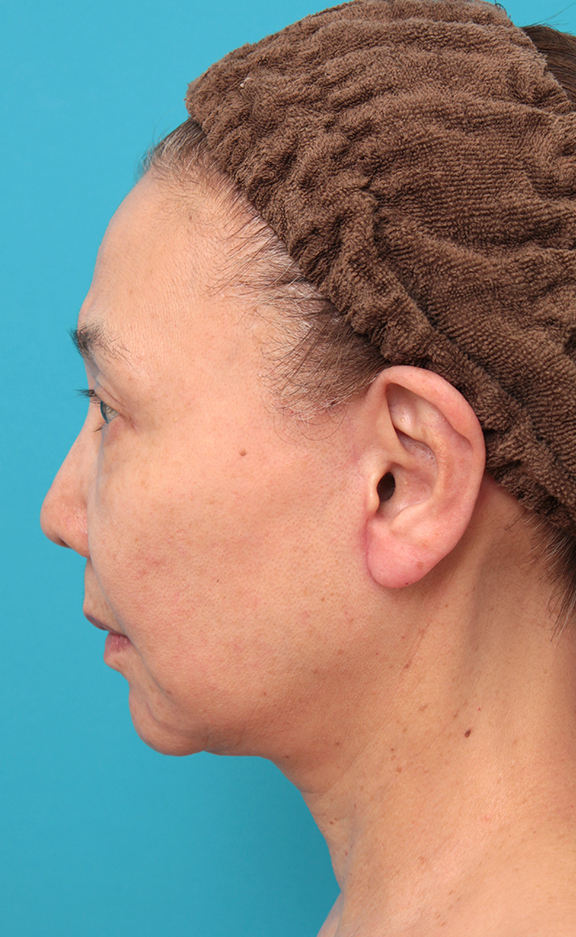 症例写真,フルフェイスリフトを行った60代女性の症例写真,After(6ヶ月後),ba_facelift007_b03.jpg