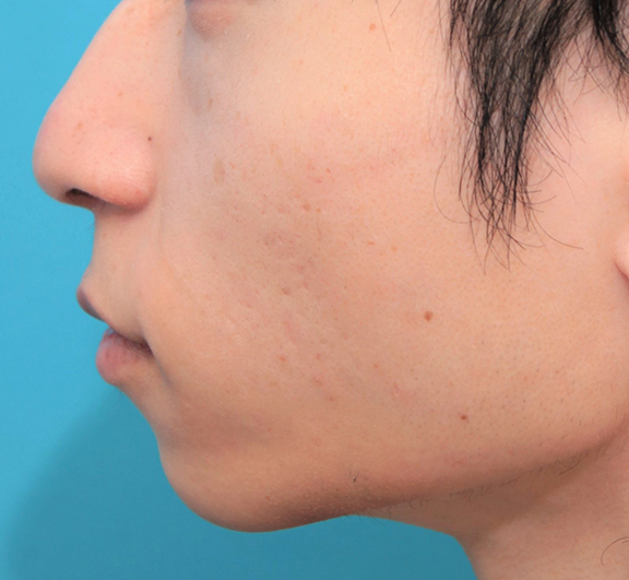 症例写真,人中短縮手術(リップリフト)で鼻の下を短くした20代男性の症例写真,After(2ヶ月後),ba_hanashita006_b03.jpg