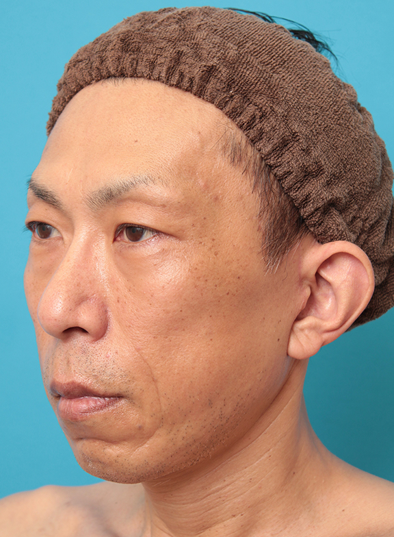 ミディアムフェイスリフト,ミディアムフェイスリフトでリフトアップした50代男性の症例写真,After(6ヶ月後),ba_mediumlift018_b02.jpg