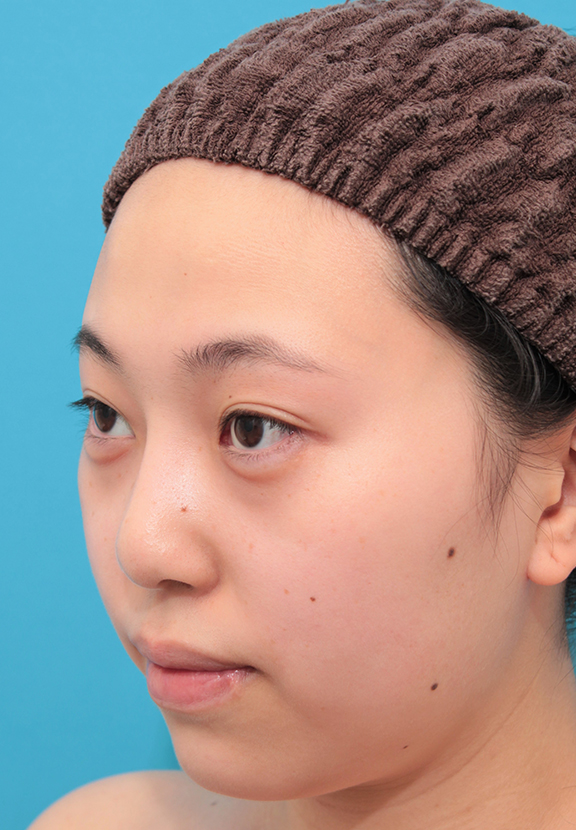 症例写真,シリコンプロテーゼで鼻筋を通した20代女性の症例写真,After(6ヶ月後),ba_ryubi1061_b02.jpg