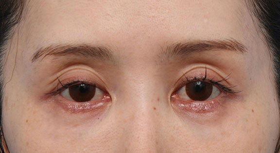 症例写真,くぼみ目修正(ヒアルロン酸注射) ヒアルロン酸の注入でくぼみ目を修正した患者様の症例,Before,ba_kubomi011_b01.jpg