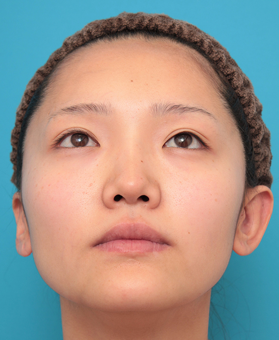 症例写真,鼻筋の長期持続型ヒアルロン酸+鼻先の耳介軟骨移植を行った20代女性の症例写真,After(2ヶ月後),ba_ryubi2041_b03.jpg