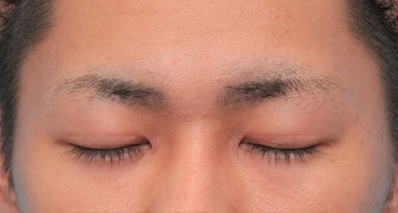 二重まぶた・全切開法,二重まぶた全切開法を行った20代男性の症例写真,After(目を閉じた状態)<br/>
(6ヶ月後),