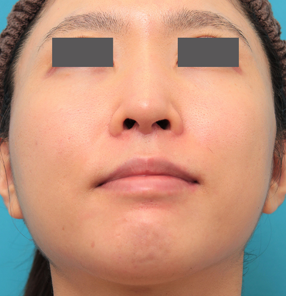 症例写真,小鼻縮小と人中短縮を同時に行った30代女性の症例写真,After(6ヶ月後),ba_biyoku053_b02.jpg