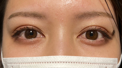 症例写真,奥二重瞼をパッチリした二重瞼にした20代女性の症例,After(メイク有り),