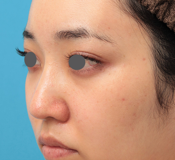 症例写真,鼻筋の長期持続型ヒアルロン酸注射+鼻先の耳介軟骨移植を行った20代女性の症例写真,After(3ヶ月後),ba_ryubi2043_b02.jpg
