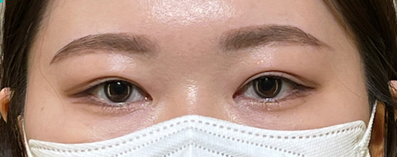 二重まぶた・全切開法で瞼が厚くても違和感のない二重に仕上げた症例写真,Before,ba_sekkai088_b01.jpg