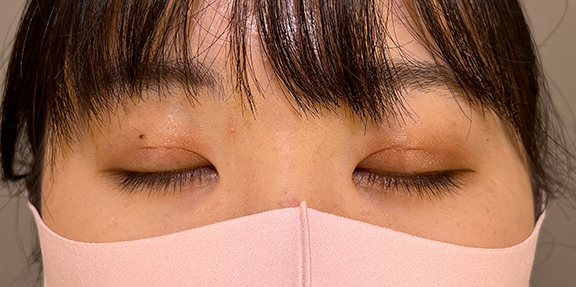 症例写真,二重まぶた・埋没法(二針固定)で末広型の二重を作った症例写真,After(1ヶ月後)<br/>
(目を閉じた状態),