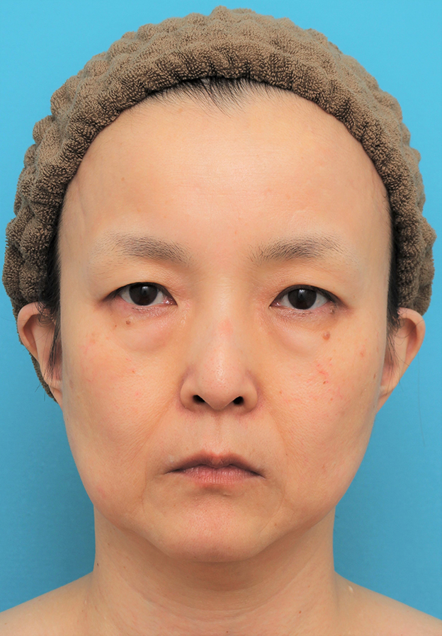 目の下の脂肪取り,ミディアムリフト+目の下脂肪取りを行った50代女性の症例写真,手術前,mainpic_mediumlift020a.jpg