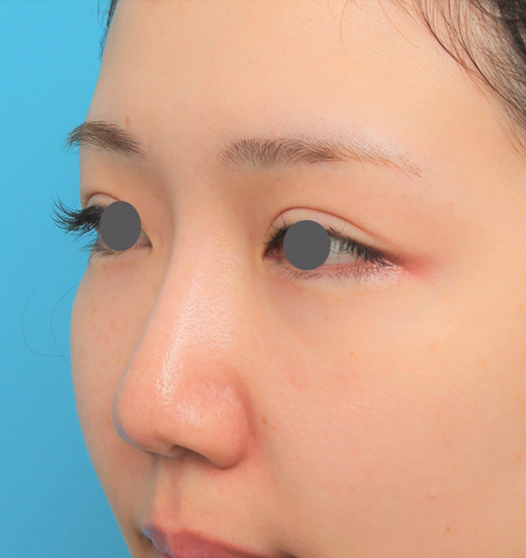 症例写真,鼻プロテーゼ+鼻柱の耳介軟骨移植+小鼻縮小を行った20代女性の症例写真,After(6ヶ月後),ba_ryubi1063_b02.jpg