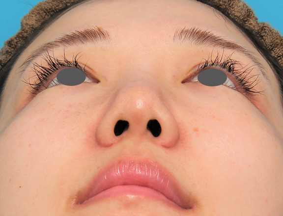 症例写真,鼻プロテーゼ+鼻柱の耳介軟骨移植+小鼻縮小を行った20代女性の症例写真,After(6ヶ月後),ba_ryubi1063_b03.jpg
