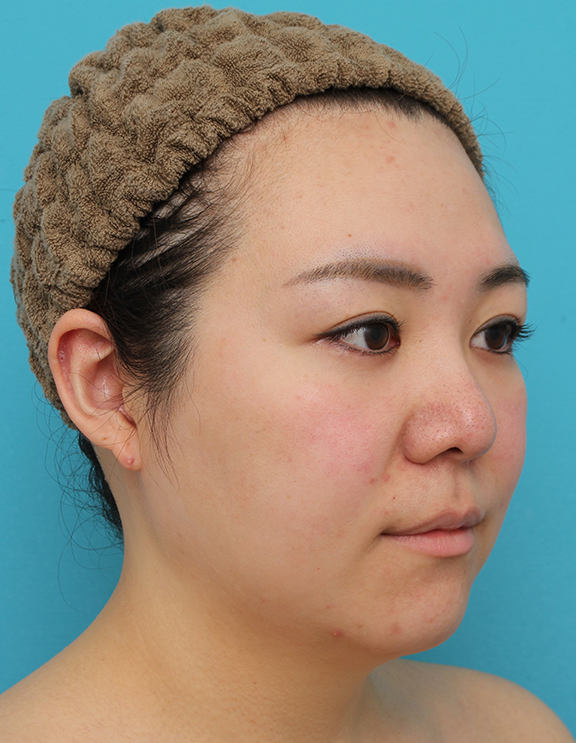 症例写真,頬~フェイスライン~顎下の脂肪吸引をした20代女性の症例写真,Before,ba_shibokyuin047_b02.jpg