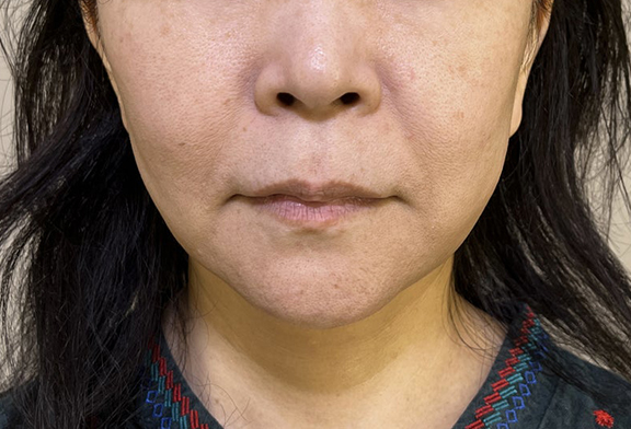 脂肪吸引（頬、あご下）,ミニフェイスリフト（頬のたるみ取り）,脂肪吸引,ミニフェイスリフト＋フェイスラインの脂肪吸引の症例写真,After（3ヶ月後）,ba_minilift014_a01.jpg